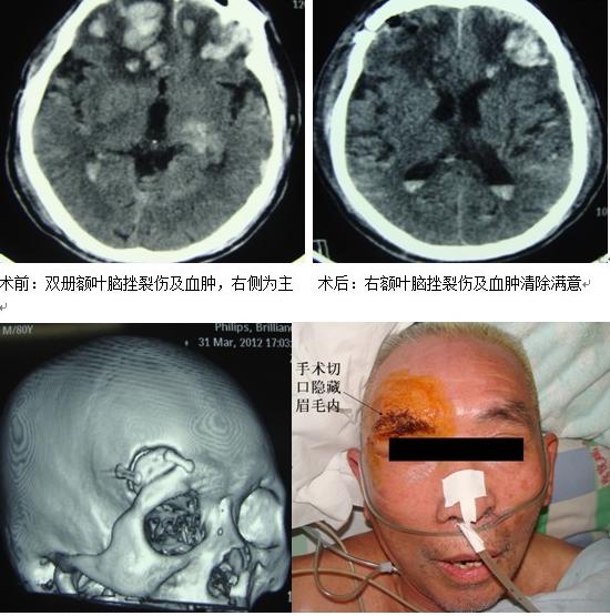 小小锁孔手术 解决重大问题