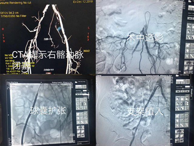 突破！肝胆腺体周围血管病外科完成首例下肢动脉血管成形术