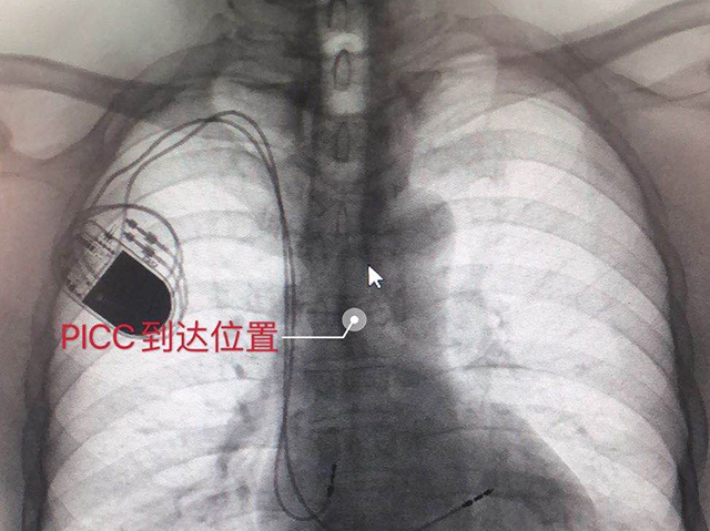 可视化技术开通血管通路，解决长期输液难题——记放疗科团队成功为一例心率失常肿瘤患者行PICC置管术