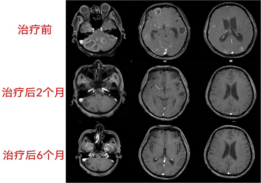 六旬老伯脑内惊见25个肿瘤射波刀助力化险为夷