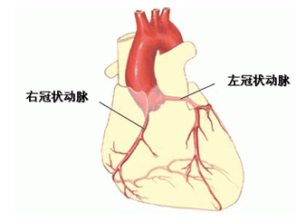 冠脉介入手术过程简图