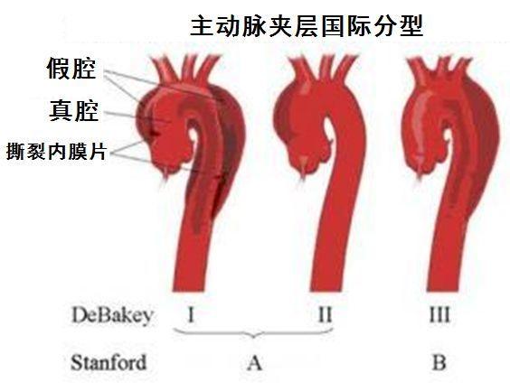 主动脉夹层——比心梗要命， 48小时内死亡率达50%