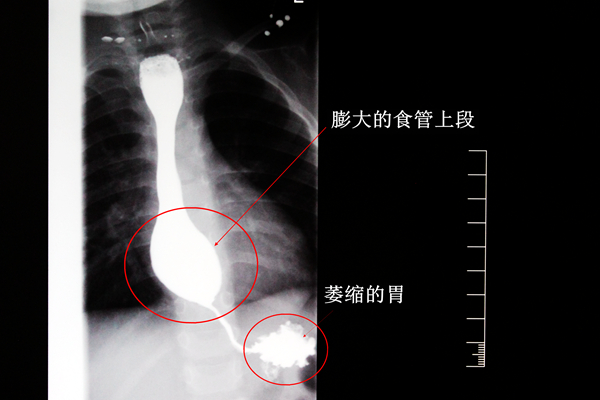 3岁至今粒米未进，食管狭窄险致胃萎缩――我院心胸外科成功为一例罕见先天性食管狭窄患儿施行手术