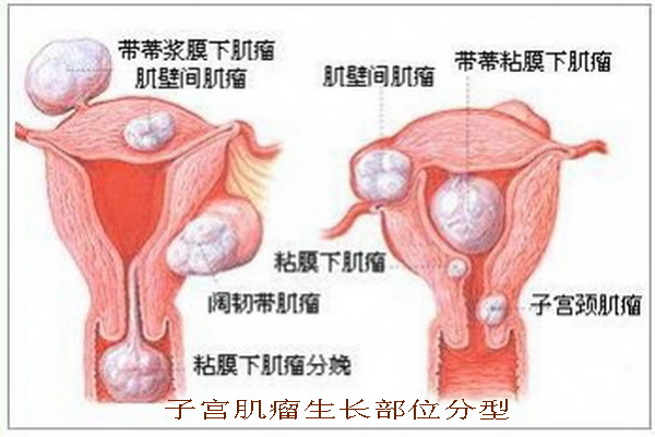 何为子宫肌瘤？