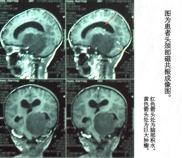 一岁幼儿右侧偏瘫先排积水再除瘤