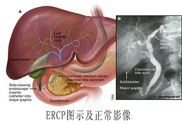 内镜下逆行胰胆管造影??无需开腹治疗胆胰腺疾病的微创方法