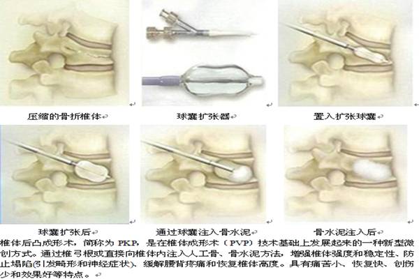 我科开展的主要脊柱微创项目简介