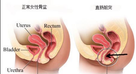 直肠前突小知识