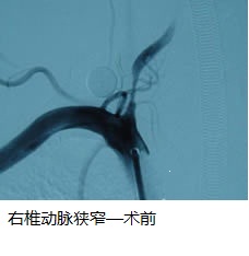 我院神经内科一区再次成功施行一例全脑血管造影术及动脉支架置入手术