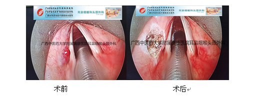 咽喉部血管瘤的临床诊治