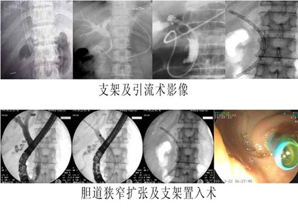 内镜下逆行胰胆管造影（ERCP）??无需开腹治疗胆胰腺疾病的微创方法