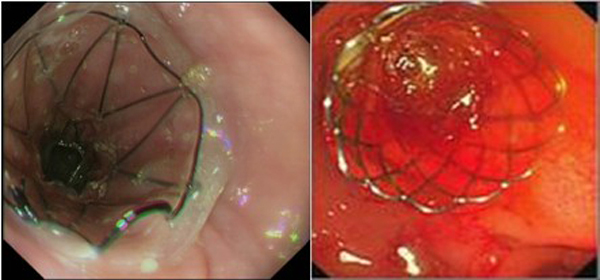消化道支架置入术