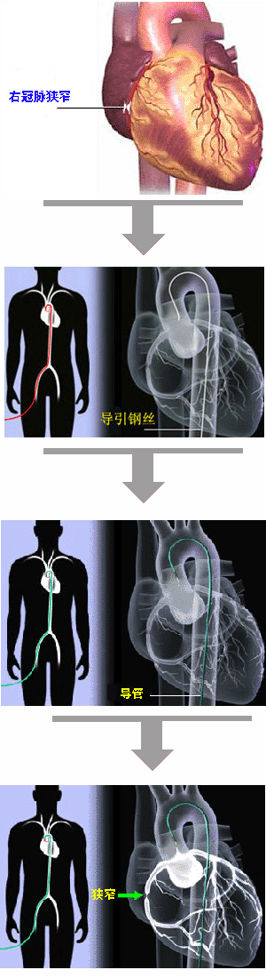 冠脉支架植入示意图