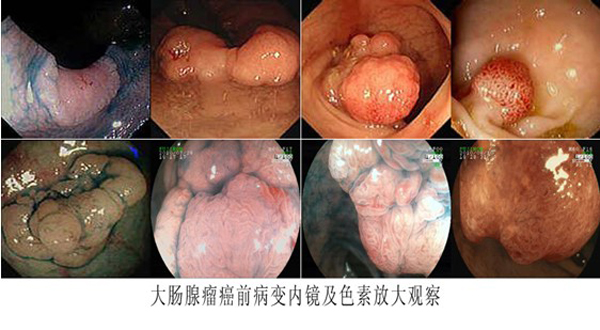 消化道癌前病变??有效防治胃肠道癌症的关键