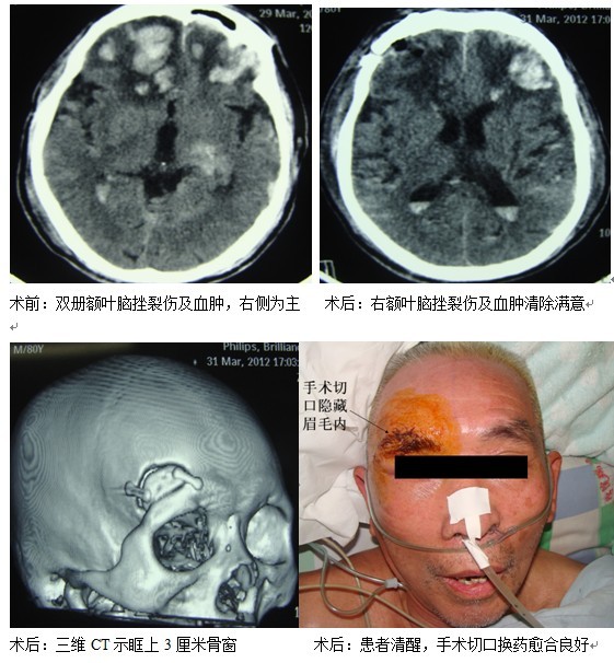 小小锁孔手术 解决重大问题