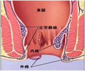 痔疮的中西医结合特色治疗