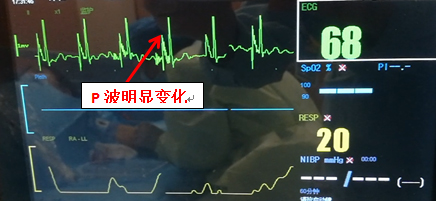 心电定位，置管无忧——乳腺科护理团队运用腔内心电定位技术提高中心静脉置管成功率