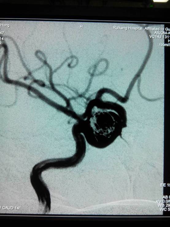 头痛睡不着？有可能是动脉瘤！ ――神经外科成功栓塞颅内动脉瘤 患者重获安眠