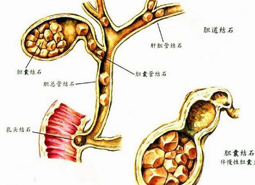 肝胆外科在湘雅彭健教授指导下不断取得突破