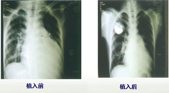 起搏器植入术