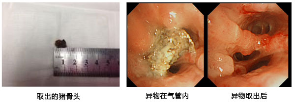 剧咳3月原是骨头作梗 纤支镜片刻解除痛苦