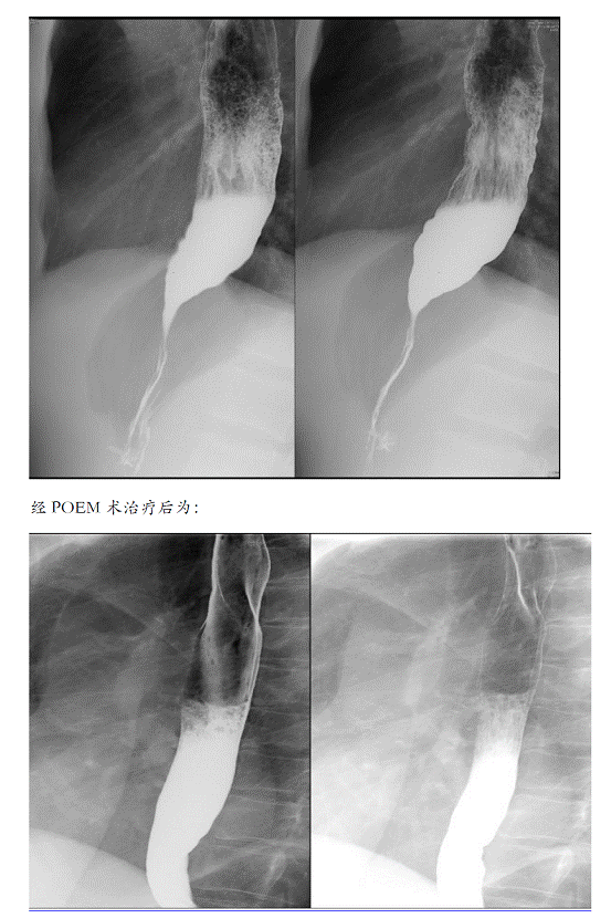 消化内科新技术---经口内镜下肌切开术治疗食道贲门失迟缓症
