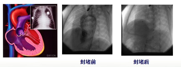 先天性心脏病室间隔缺损（VSD）介入治疗