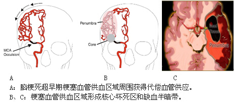 溶栓治疗-挥向缺血性脑卒中病魔的利剑