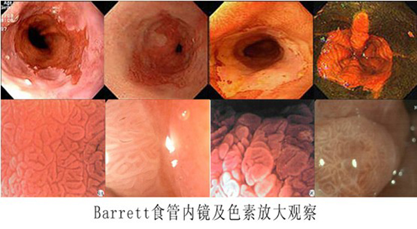 消化道癌前病变??有效防治胃肠道癌症的关键