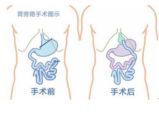 胃旁路手术-2型糖尿病患者的新选择