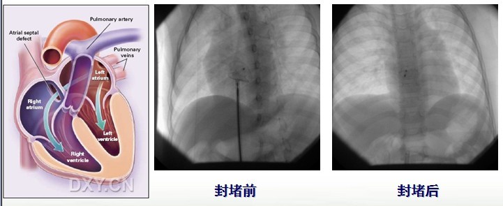 先天性心脏病房间隔缺损介入治疗