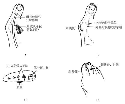 骨四肢二区拟系统开展多种足踝外科手术