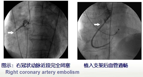 冠心病的介入技术