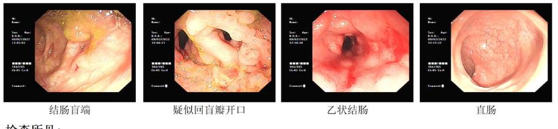 反复腹泻、腹痛、消瘦（克罗恩病）患者迎来福音——乌司奴单抗正式纳入医保报销