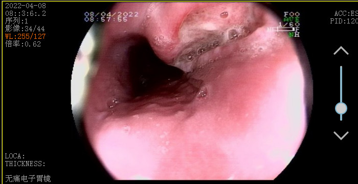 反复胸痛、吞咽困难——一例特殊的食道溃疡！警惕原发性食管结核