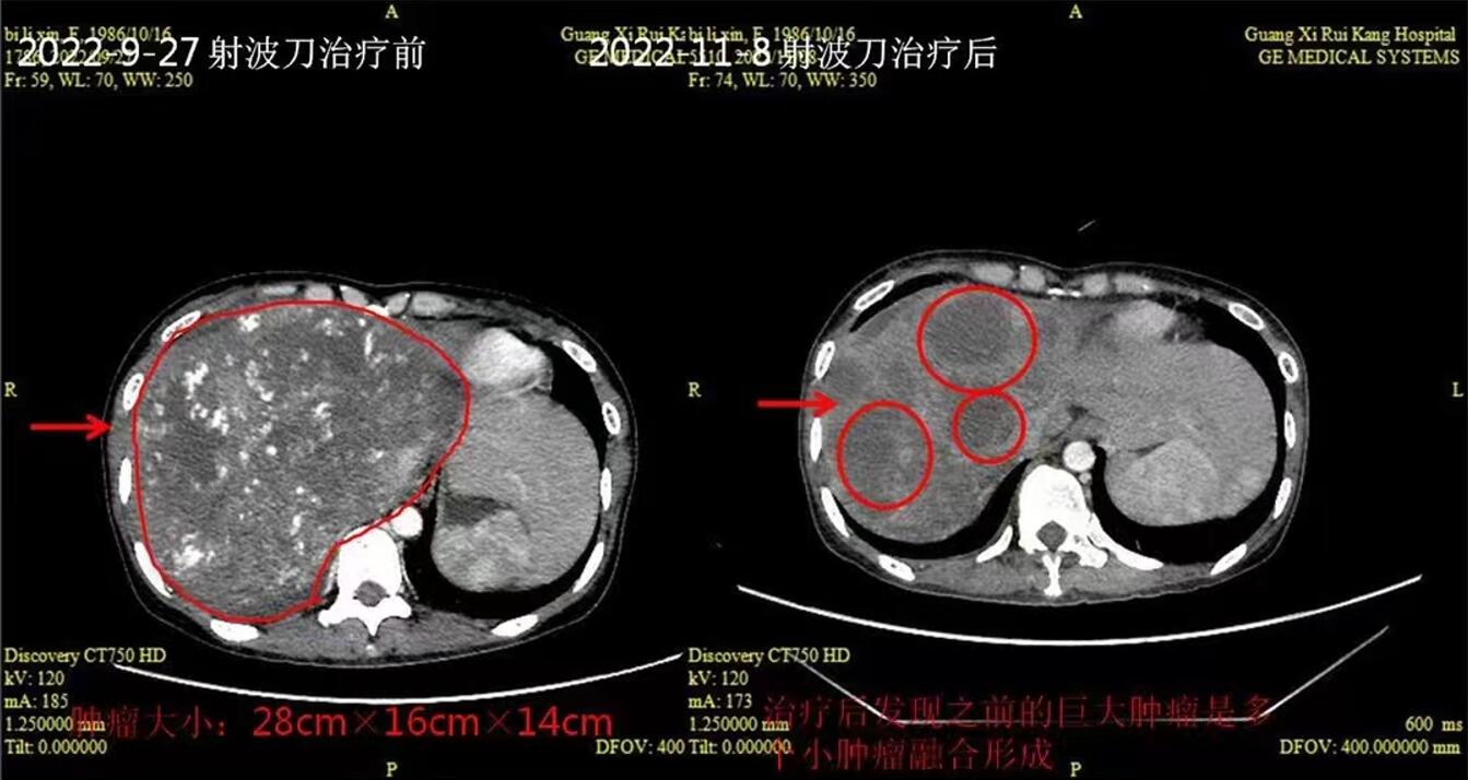 射波刀治疗巨大肿瘤效果好不好？28cm肝癌的治疗一探究竟