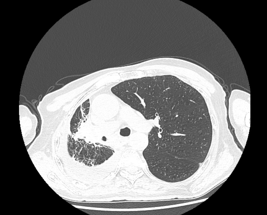 【改善医疗服务 提升患者体验】肺癌已七年，他感慨：“健康的活着真好”！