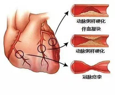 体检显示甘油三酯高，是因为血液里的油太多？还易导致心梗？