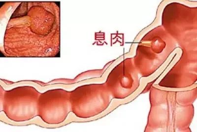 95%的大肠癌是由肠息肉转变而来…肠息肉到底要不要切？