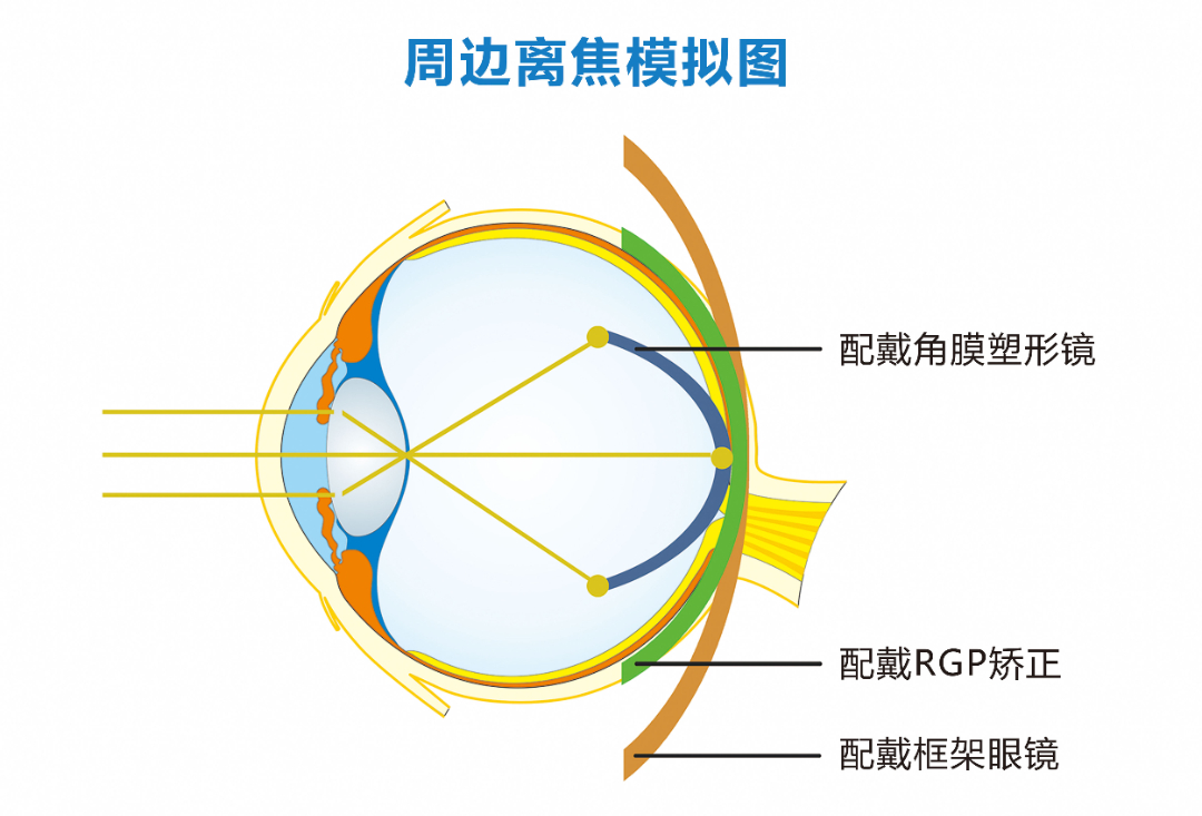 戴OK镜的小砂糖橘必看！寒假最全角膜塑形镜使用指南来了！