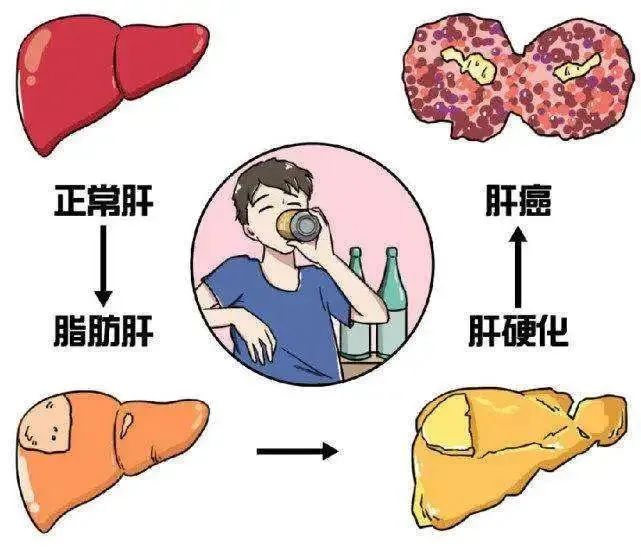 全国爱肝日 | 脂肪肝“不痛不痒”就不用管？错！