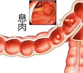 息肉还分肿瘤性息肉和非肿瘤性息肉，其中它恶变风险极高
