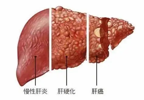 肝硬化别拖！早期肝硬化及时干预，可逆转！