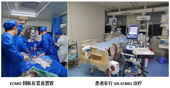 【改善医疗服务 提升患者体验】急性多发肺动脉栓塞、呼吸心跳骤停——死亡边缘的她幸好遇到我院ECMO团队