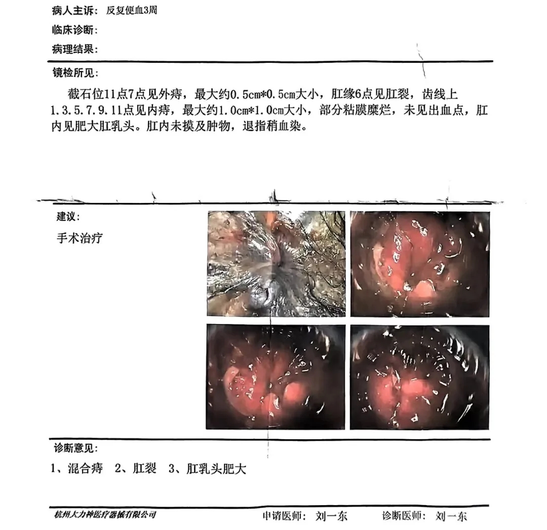 揭秘：痔疮手术没你想象的那么可怕